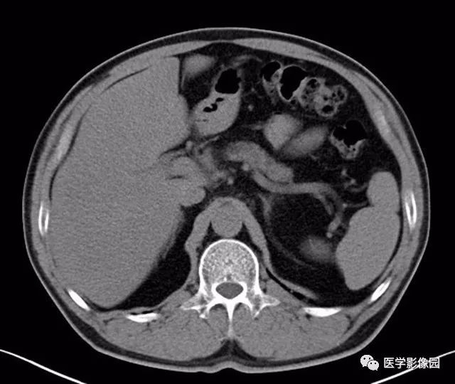 【病例】肿块型胰腺炎1例CT影像表现 【病例】肿块型胰腺炎1例CT影像表现