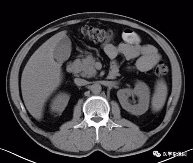 【病例】肿块型胰腺炎1例CT影像表现 【病例】肿块型胰腺炎1例CT影像表现