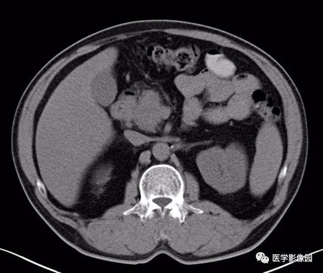 【病例】肿块型胰腺炎1例CT影像表现 【病例】肿块型胰腺炎1例CT影像表现