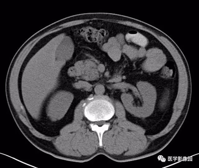 【病例】肿块型胰腺炎1例CT影像表现 【病例】肿块型胰腺炎1例CT影像表现