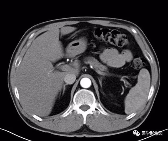【病例】肿块型胰腺炎1例CT影像表现 【病例】肿块型胰腺炎1例CT影像表现