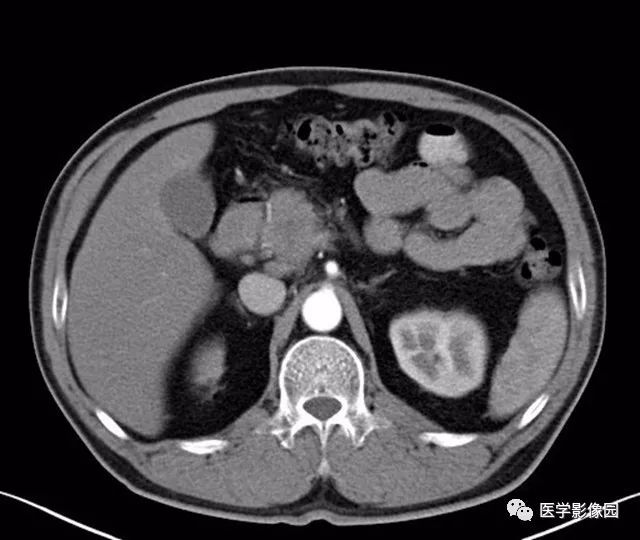 【病例】肿块型胰腺炎1例CT影像表现 【病例】肿块型胰腺炎1例CT影像表现