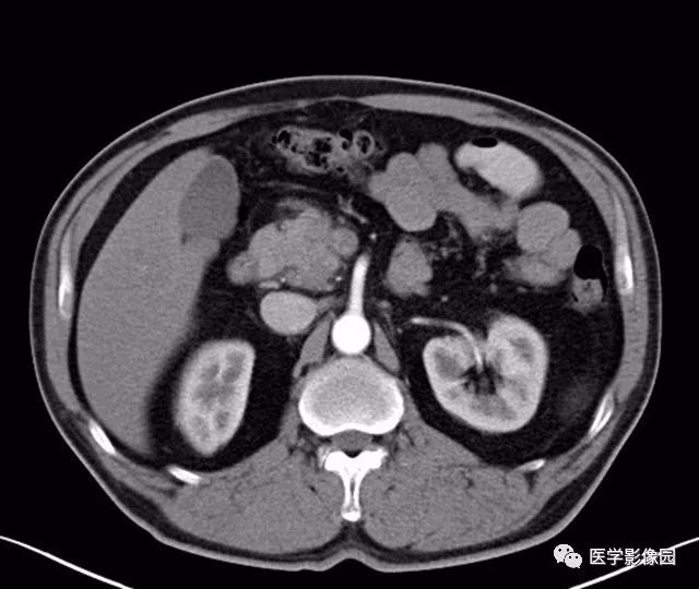 【病例】肿块型胰腺炎1例CT影像表现 【病例】肿块型胰腺炎1例CT影像表现