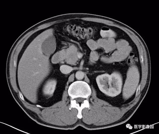 【病例】肿块型胰腺炎1例CT影像表现 【病例】肿块型胰腺炎1例CT影像表现