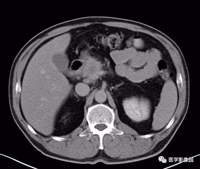 【病例】肿块型胰腺炎1例CT影像表现