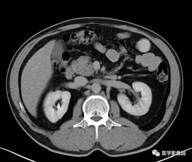【病例】肿块型胰腺炎1例CT影像表现 【病例】肿块型胰腺炎1例CT影像表现