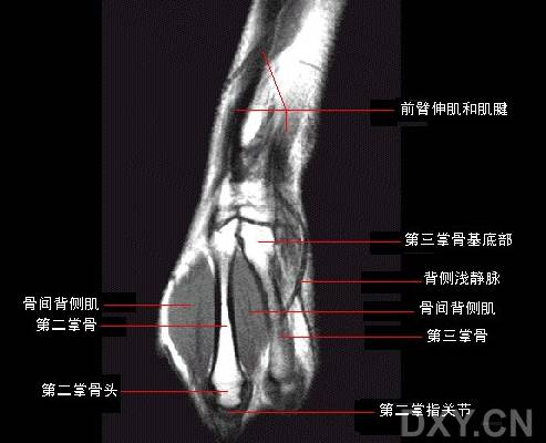 腕关节系统解剖图+冠状MRI 腕关节系统解剖图+冠状MRI