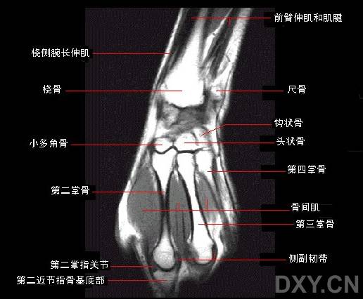 腕关节系统解剖图+冠状MRI 腕关节系统解剖图+冠状MRI
