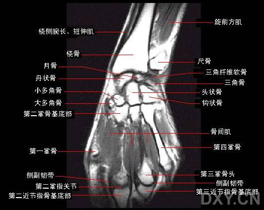 腕关节系统解剖图+冠状MRI 腕关节系统解剖图+冠状MRI