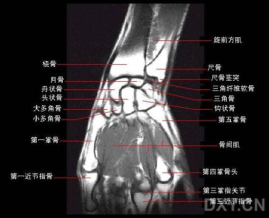 腕关节系统解剖图+冠状MRI 腕关节系统解剖图+冠状MRI