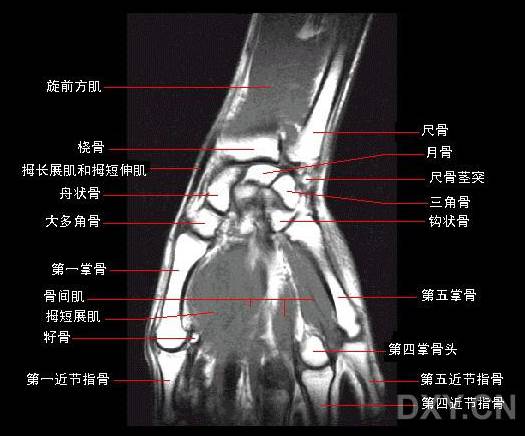腕关节系统解剖图+冠状MRI 腕关节系统解剖图+冠状MRI