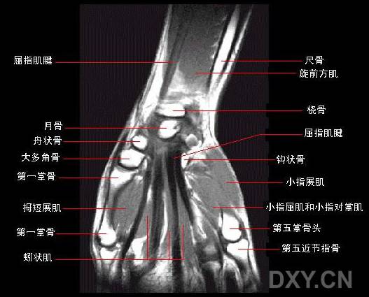 腕关节系统解剖图+冠状MRI 腕关节系统解剖图+冠状MRI