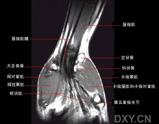 腕关节系统解剖图+冠状MRI 腕关节系统解剖图+冠状MRI