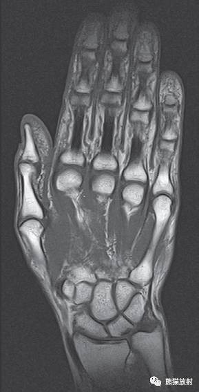 腕关节系统解剖图+冠状MRI 腕关节系统解剖图+冠状MRI