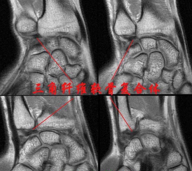 腕关节系统解剖图+冠状MRI 腕关节系统解剖图+冠状MRI