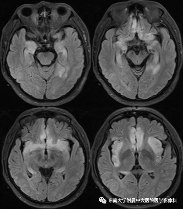【病例】单纯疱疹型病毒性脑炎1例MR