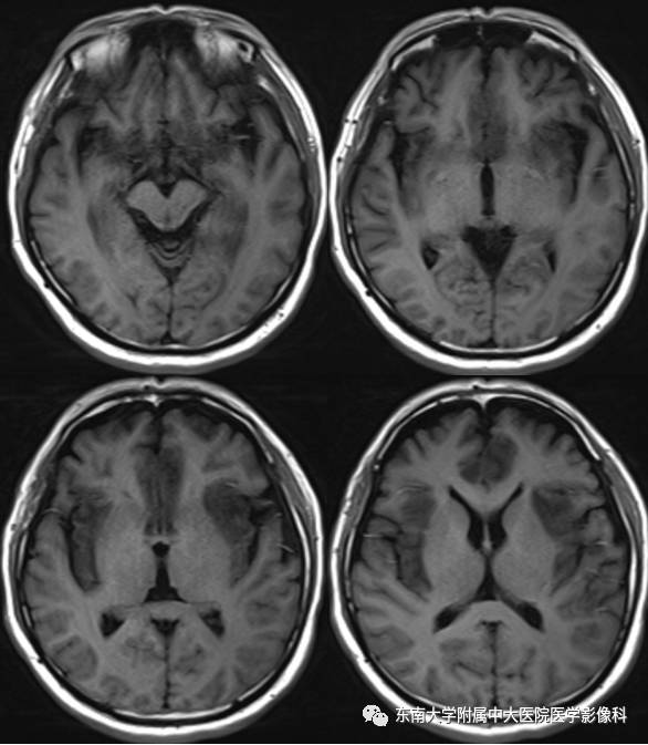 【病例】单纯疱疹型病毒性脑炎1例MR 【病例】单纯疱疹型病毒性脑炎1例MR