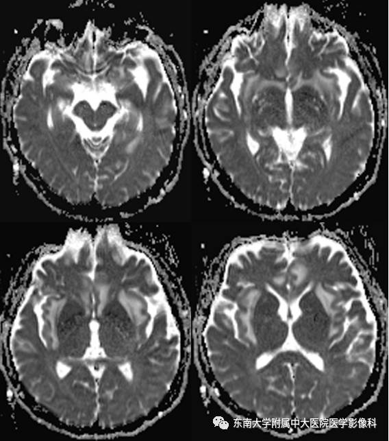 【病例】单纯疱疹型病毒性脑炎1例MR 【病例】单纯疱疹型病毒性脑炎1例MR
