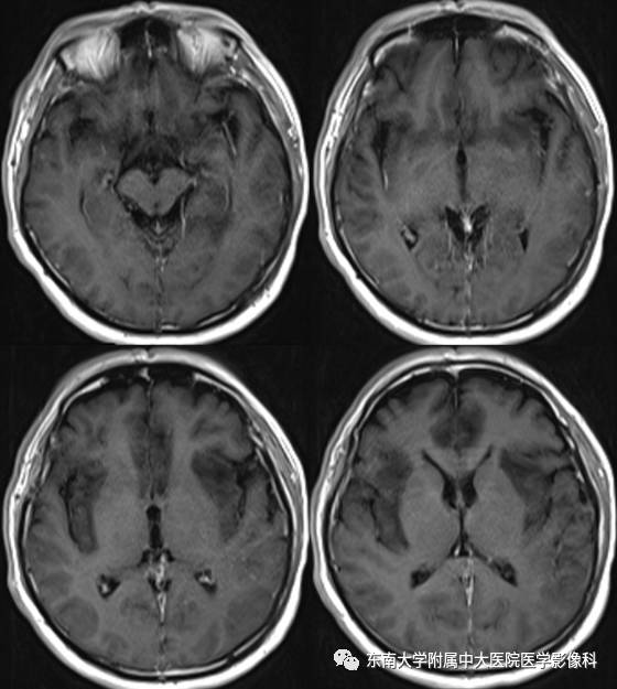 【病例】单纯疱疹型病毒性脑炎1例MR 【病例】单纯疱疹型病毒性脑炎1例MR