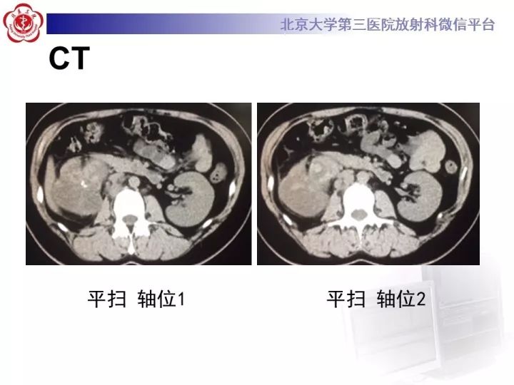 【病例】右肾乳头状肾细胞癌1例CT影像表现