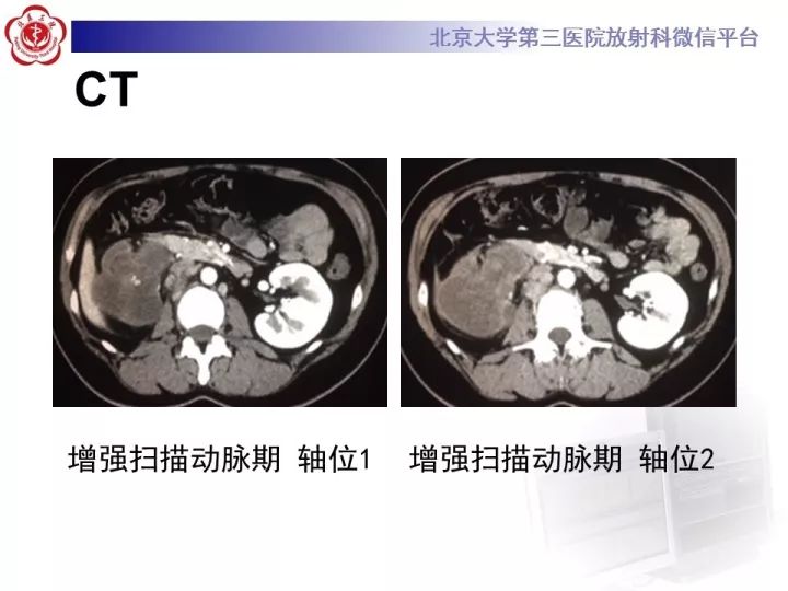 【病例】右肾乳头状肾细胞癌1例CT影像表现