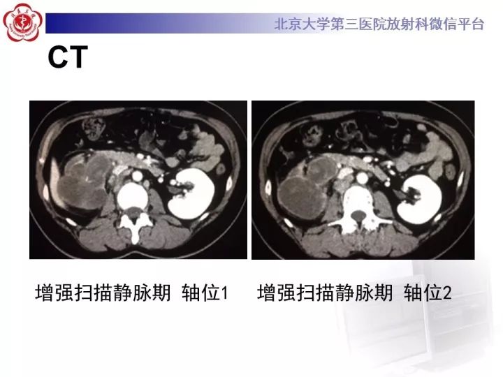 【病例】右肾乳头状肾细胞癌1例CT影像表现