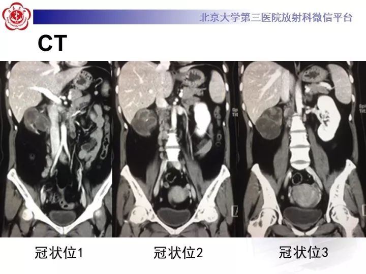 【病例】右肾乳头状肾细胞癌1例CT影像表现