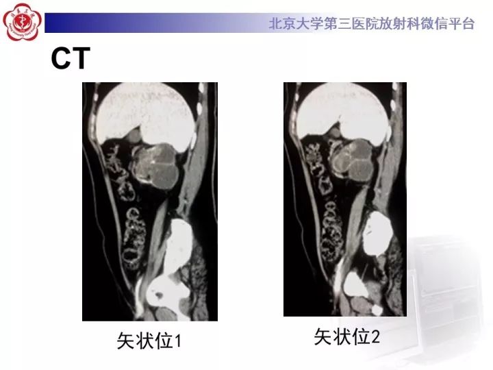 【病例】右肾乳头状肾细胞癌1例CT影像表现