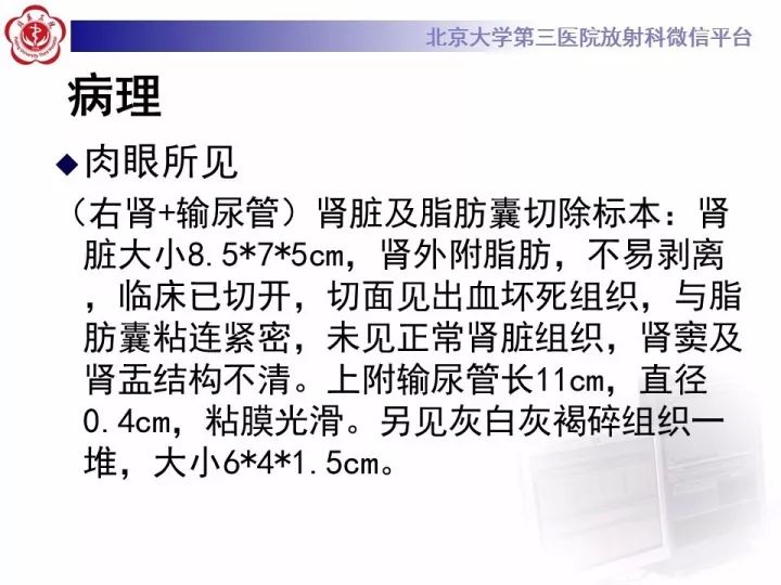 【病例】右肾乳头状肾细胞癌1例CT影像表现