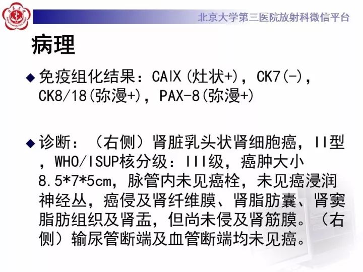 【病例】右肾乳头状肾细胞癌1例CT影像表现
