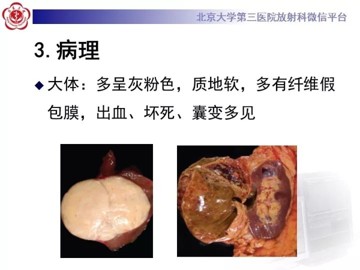 【病例】右肾乳头状肾细胞癌1例CT影像表现