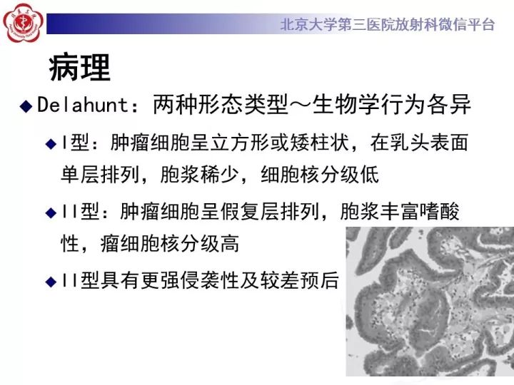 【病例】右肾乳头状肾细胞癌1例CT影像表现