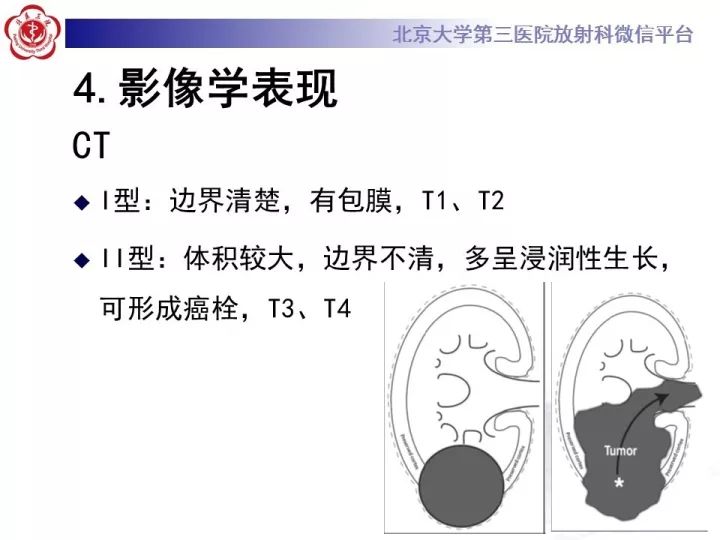 【病例】右肾乳头状肾细胞癌1例CT影像表现