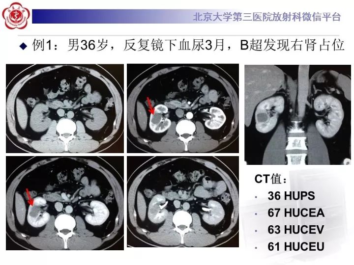 【病例】右肾乳头状肾细胞癌1例CT影像表现