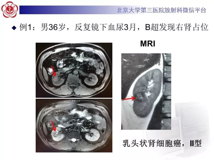 【病例】右肾乳头状肾细胞癌1例CT影像表现