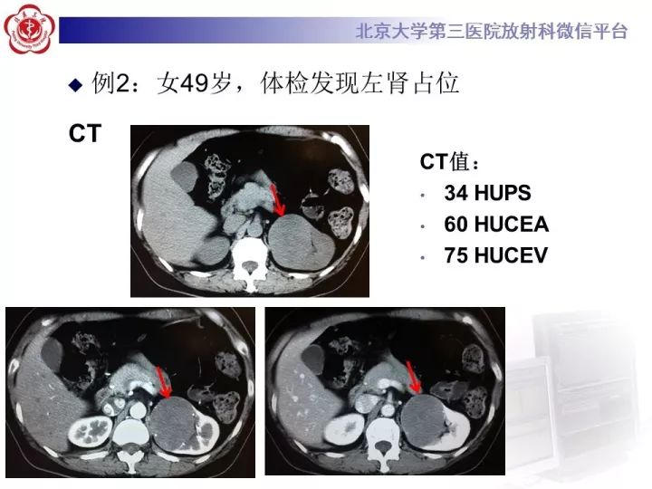 【病例】右肾乳头状肾细胞癌1例CT影像表现
