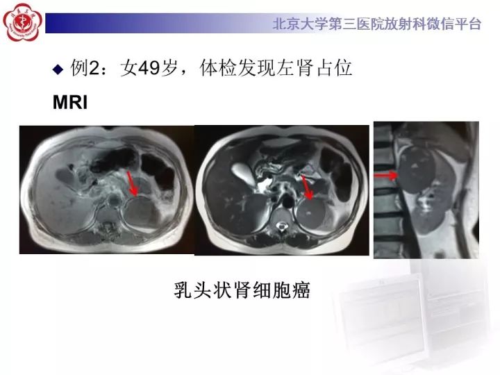 【病例】右肾乳头状肾细胞癌1例CT影像表现