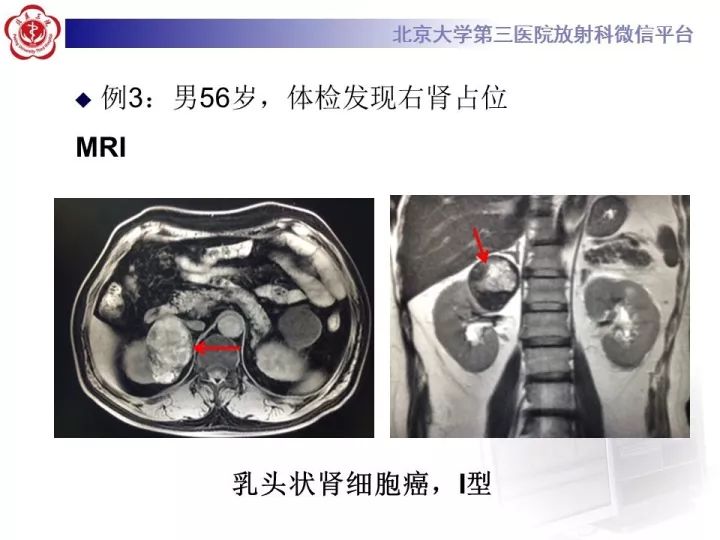 【病例】右肾乳头状肾细胞癌1例CT影像表现