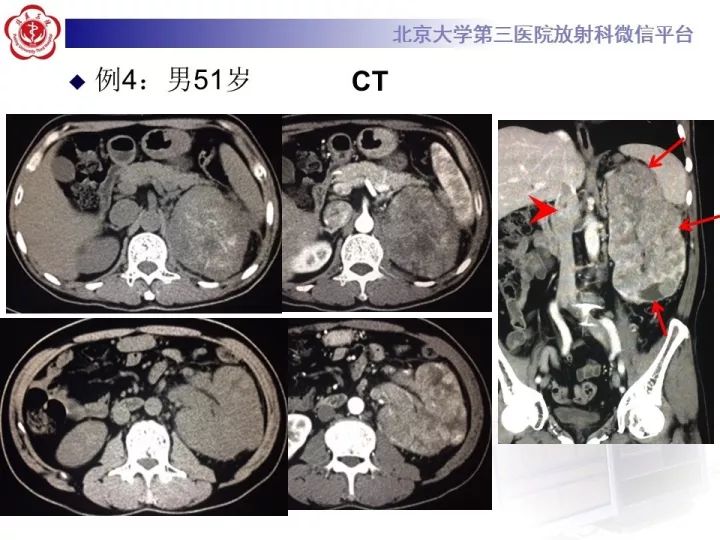 【病例】右肾乳头状肾细胞癌1例CT影像表现