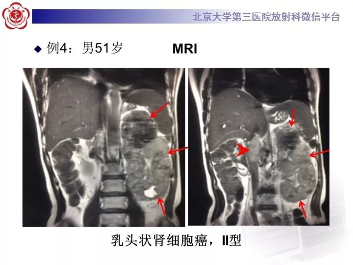 【病例】右肾乳头状肾细胞癌1例CT影像表现