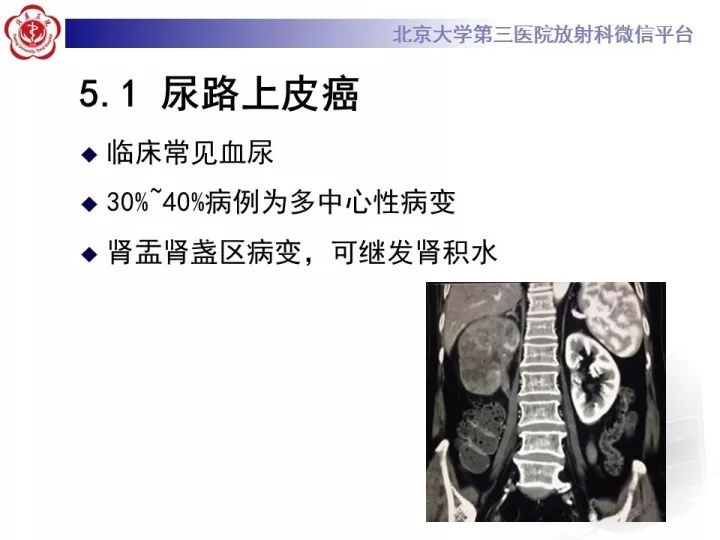 【病例】右肾乳头状肾细胞癌1例CT影像表现