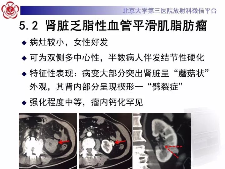 【病例】右肾乳头状肾细胞癌1例CT影像表现