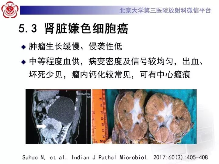 【病例】右肾乳头状肾细胞癌1例CT影像表现