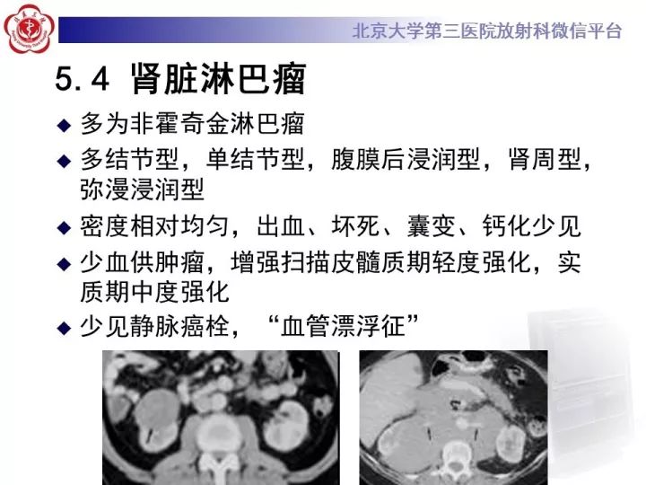 【病例】右肾乳头状肾细胞癌1例CT影像表现