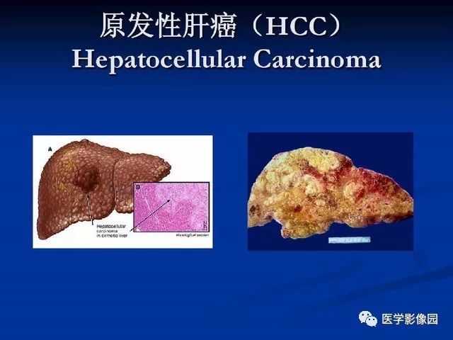 【PPT】原发性肝癌的CT技术和诊断指南