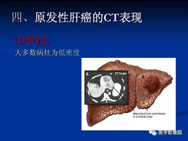 【PPT】原发性肝癌的CT技术和诊断指南
