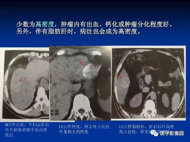 【PPT】原发性肝癌的CT技术和诊断指南