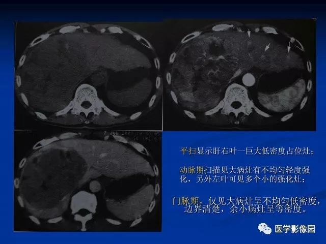 【PPT】原发性肝癌的CT技术和诊断指南