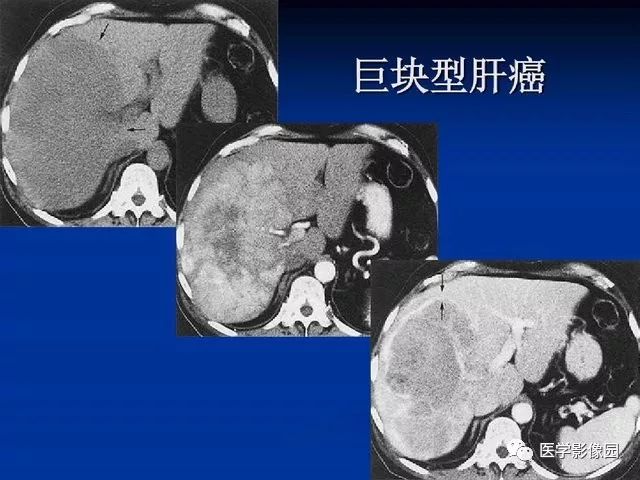 【PPT】原发性肝癌的CT技术和诊断指南