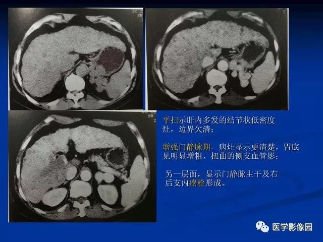 【PPT】原发性肝癌的CT技术和诊断指南